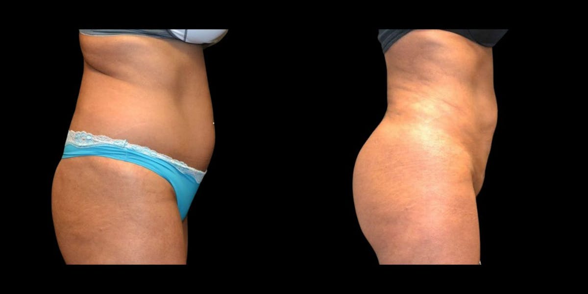 Brazilian Butt Lift Before & After Gallery - Patient 338513 - Image 1