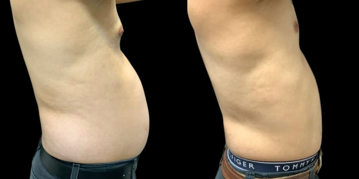 Liposuction Before & After Gallery - Patient 208427 - Image 1
