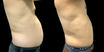 Liposuction Before & After Gallery - Patient 208427 - Image 1