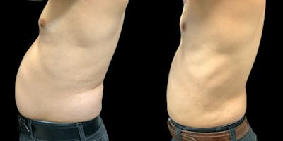 Liposuction Before & After Gallery - Patient 153856 - Image 1