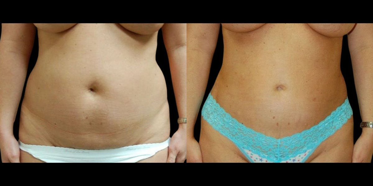 Liposuction Before & After Gallery - Patient 240189 - Image 1
