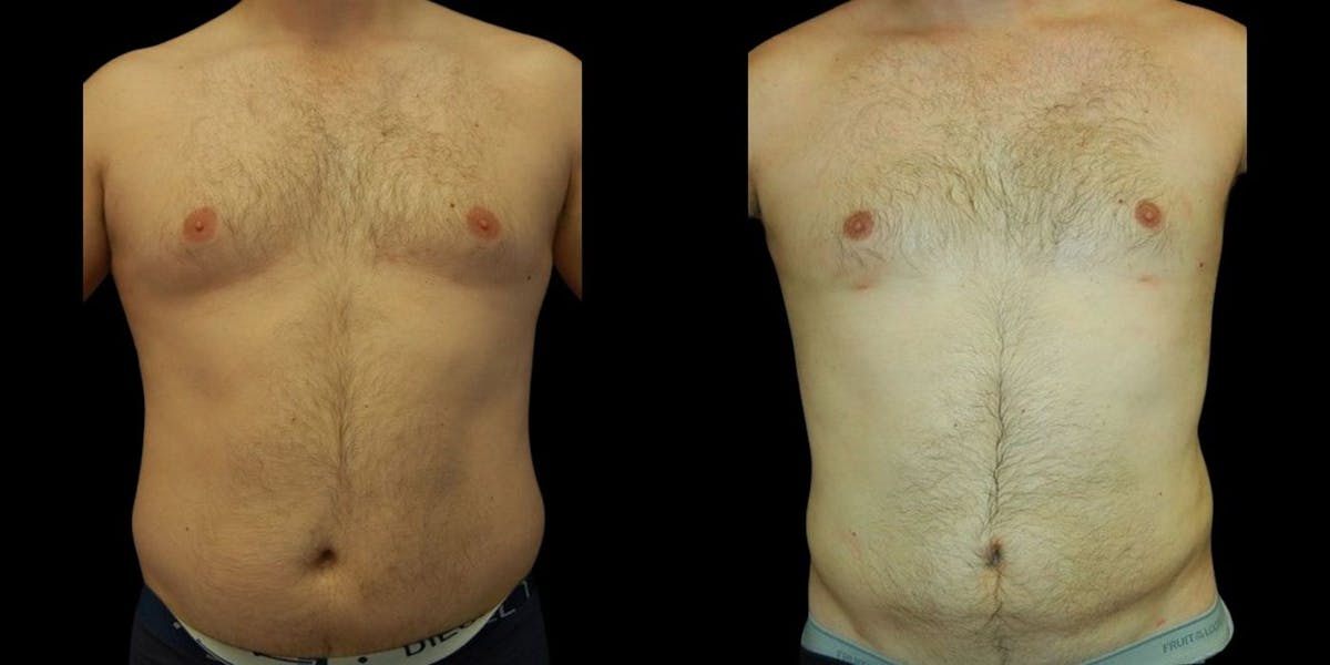 Liposuction Before & After Gallery - Patient 424819 - Image 1