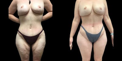 Thigh Lift Before & After Gallery - Patient 401952 - Image 1
