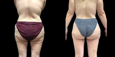 Thigh Lift Before & After Gallery - Patient 213745 - Image 1