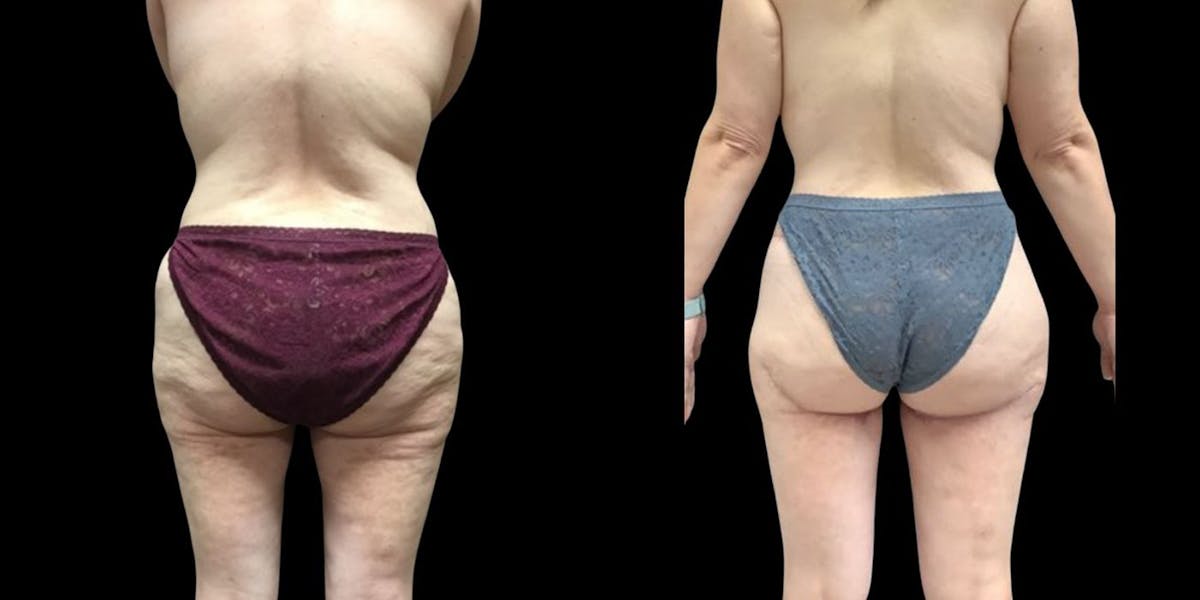 Thigh Lift Before & After Gallery - Patient 213745 - Image 1