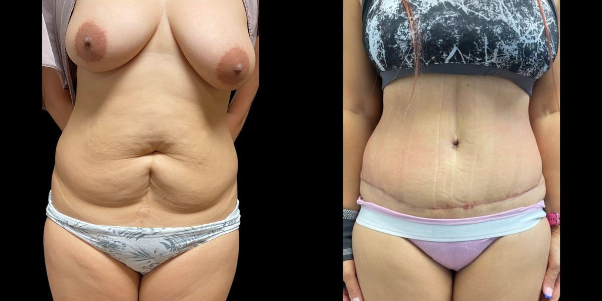Tummy Tuck Before & After Gallery - Patient 424776 - Image 1
