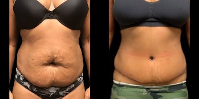 Tummy Tuck Before & After Gallery - Patient 103349 - Image 1