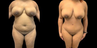 Tummy Tuck Before & After Gallery - Patient 356974 - Image 1