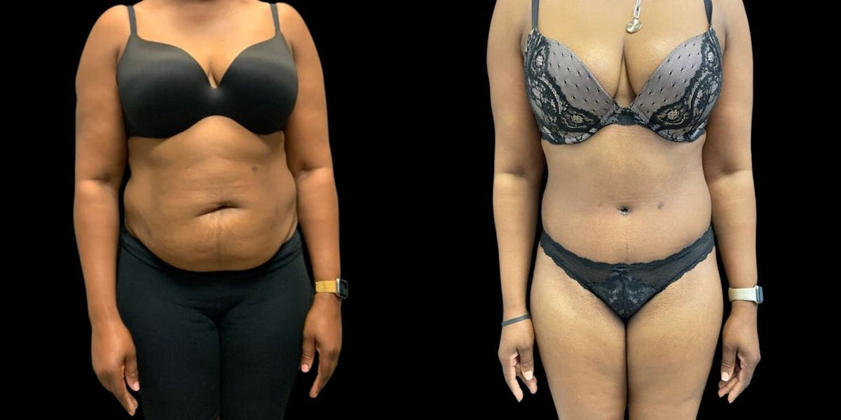 Tummy Tuck Before & After Gallery - Patient 317093 - Image 1