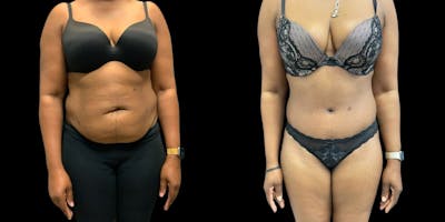 Tummy Tuck Before & After Gallery - Patient 317093 - Image 1
