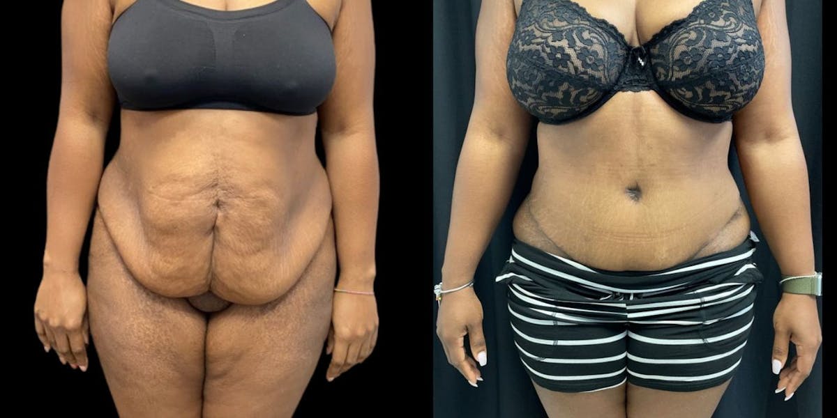 Tummy Tuck Before & After Gallery - Patient 282486 - Image 1