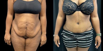 Tummy Tuck Before & After Gallery - Patient 282486 - Image 1