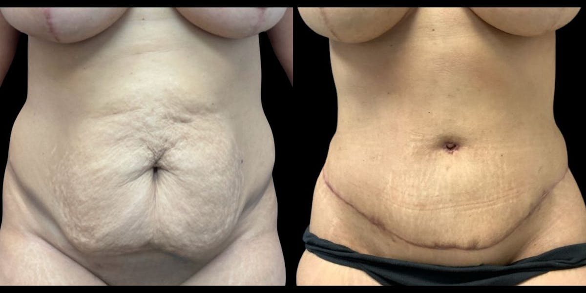Tummy Tuck Before & After Gallery - Patient 220278 - Image 1