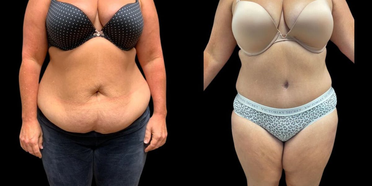 Tummy Tuck Before & After Gallery - Patient 158917 - Image 1