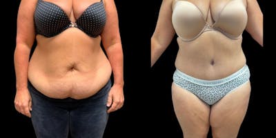 Tummy Tuck Before & After Gallery - Patient 158917 - Image 1