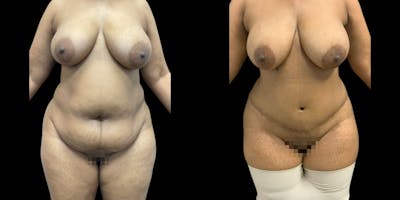 Tummy Tuck Before & After Gallery - Patient 145361 - Image 1