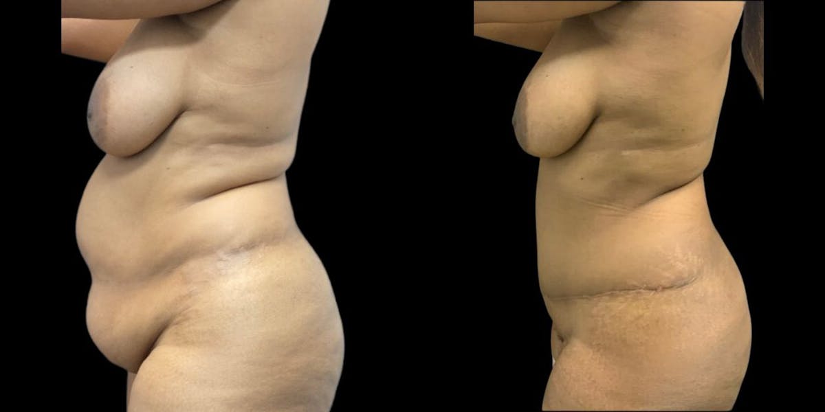 Tummy Tuck Before & After Gallery - Patient 420490 - Image 1