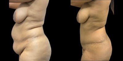 Tummy Tuck Before & After Gallery - Patient 420490 - Image 1