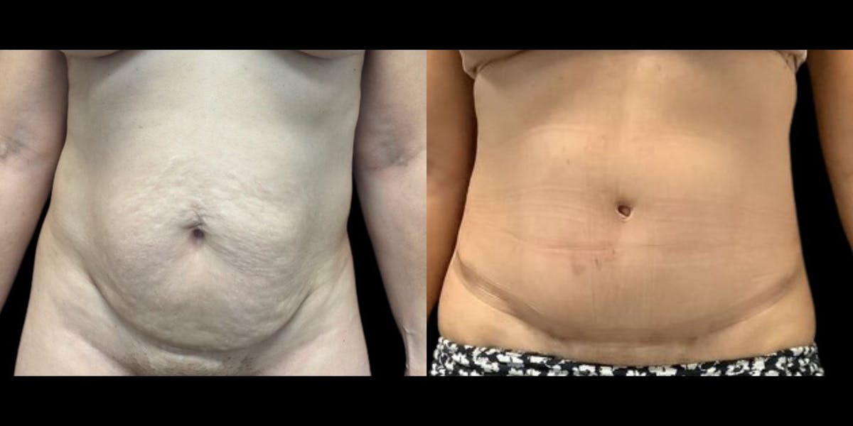 Tummy Tuck Before & After Gallery - Patient 352350 - Image 1