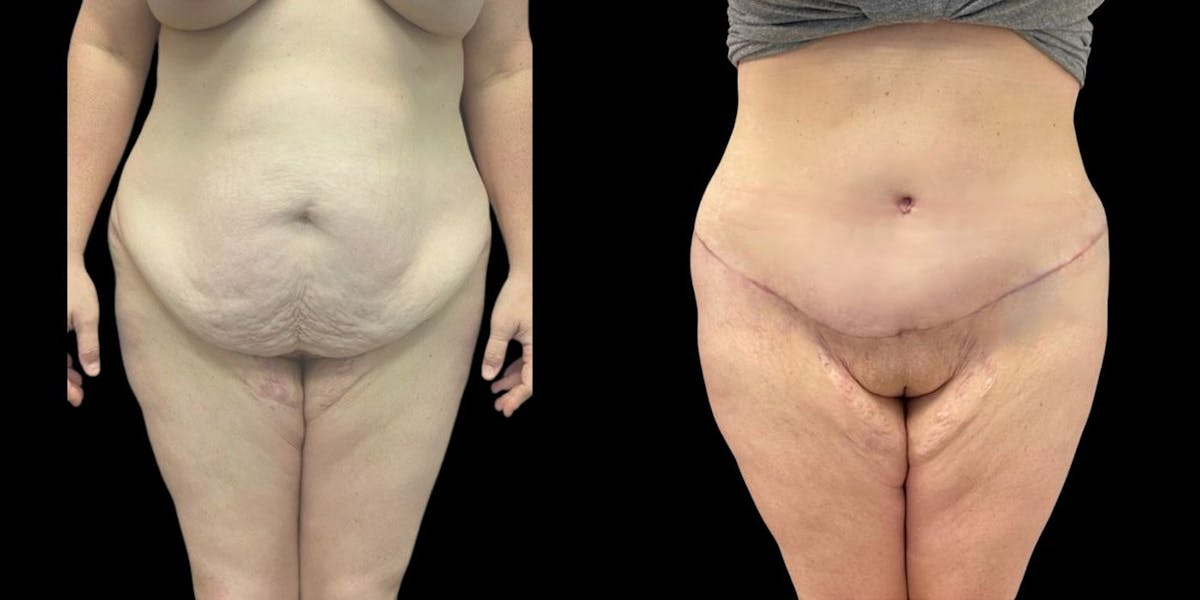 Tummy Tuck Before & After Gallery - Patient 162745 - Image 1