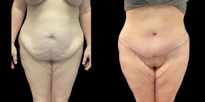 Tummy Tuck Before & After Gallery - Patient 162745 - Image 1