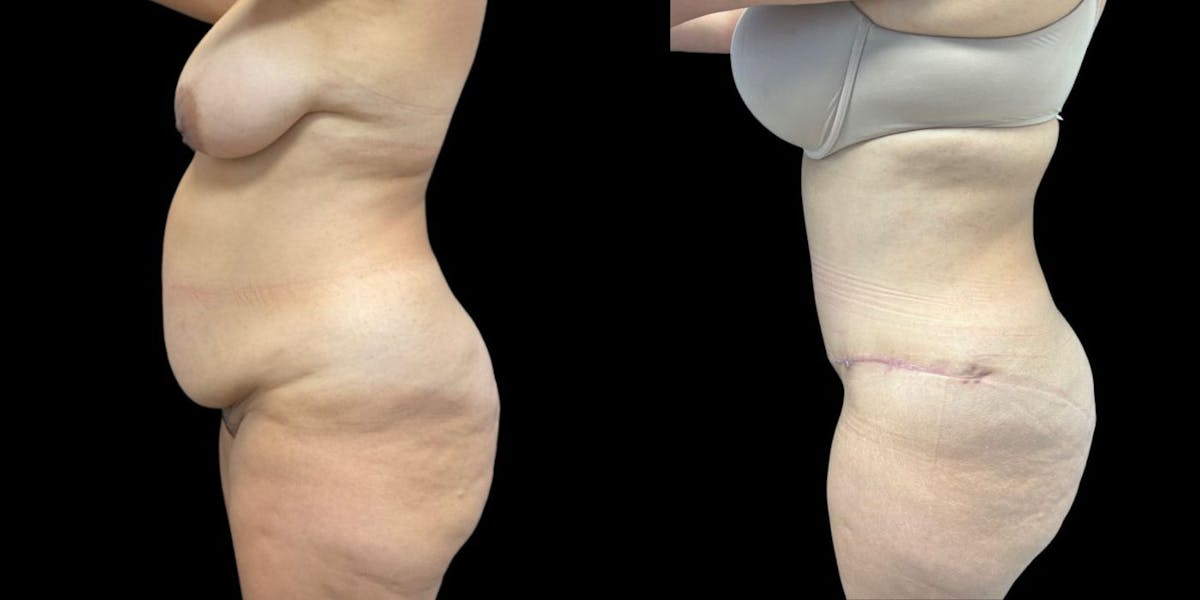 Tummy Tuck Before & After Gallery - Patient 860203 - Image 1