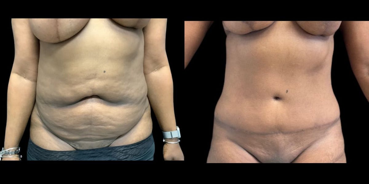Tummy Tuck Before & After Gallery - Patient 385365 - Image 1