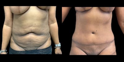 Tummy Tuck Before & After Gallery - Patient 385365 - Image 1