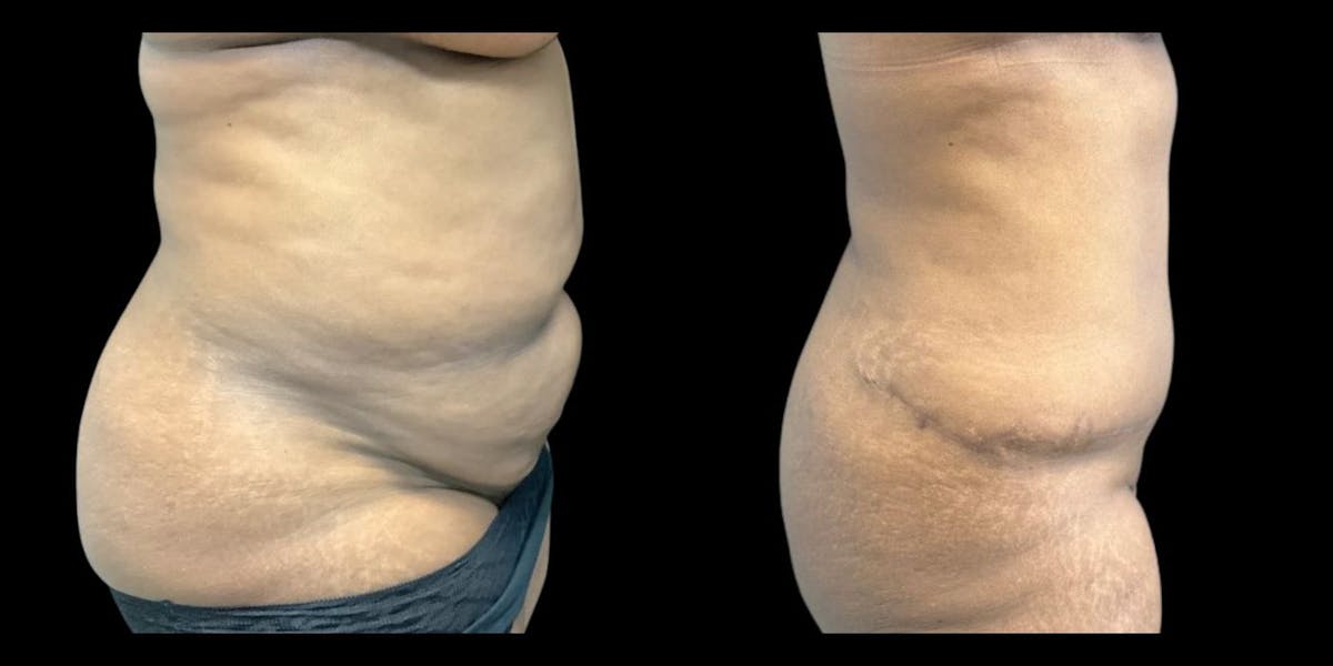 Tummy Tuck Before & After Gallery - Patient 238865 - Image 1