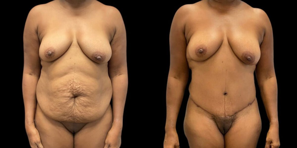 Tummy Tuck Before & After Gallery - Patient 343258 - Image 1