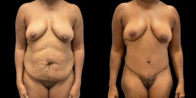 Tummy Tuck Before & After Gallery - Patient 343258 - Image 1