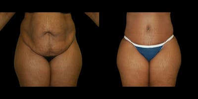 Tummy Tuck Before & After Gallery - Patient 116548 - Image 1