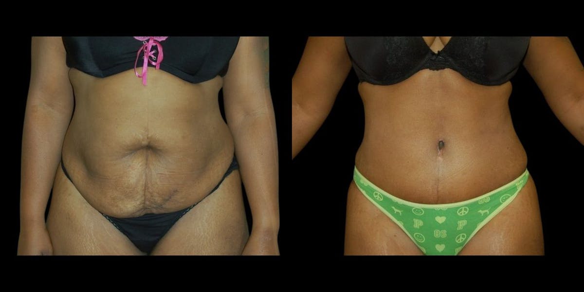 Tummy Tuck Before & After Gallery - Patient 119360 - Image 1