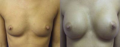 Breast Augmentation Before & After Gallery - Patient 644529 - Image 1