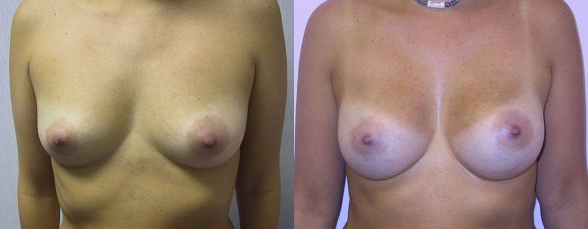 Breast Augmentation Before & After Gallery - Patient 353777 - Image 1
