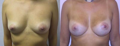 Breast Augmentation Before & After Gallery - Patient 353777 - Image 1