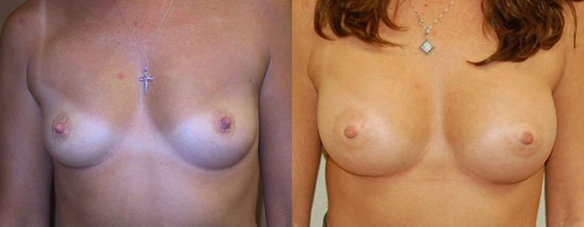 Breast Augmentation Before & After Gallery - Patient 224572 - Image 1