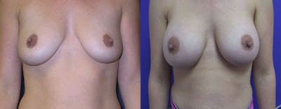 Breast Augmentation Before & After Gallery - Patient 349790 - Image 1