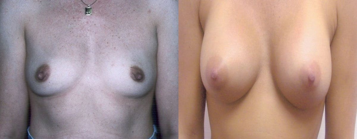 Breast Augmentation Before & After Gallery - Patient 226446 - Image 1