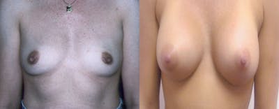 Breast Augmentation Before & After Gallery - Patient 226446 - Image 1
