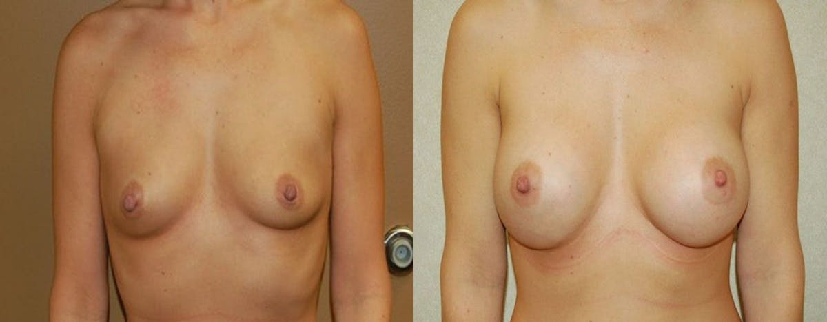Breast Augmentation Before & After Gallery - Patient 366840 - Image 1