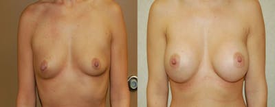 Breast Augmentation Before & After Gallery - Patient 366840 - Image 1