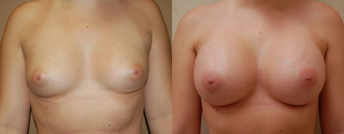 Breast Augmentation Before & After Gallery - Patient 371293 - Image 1