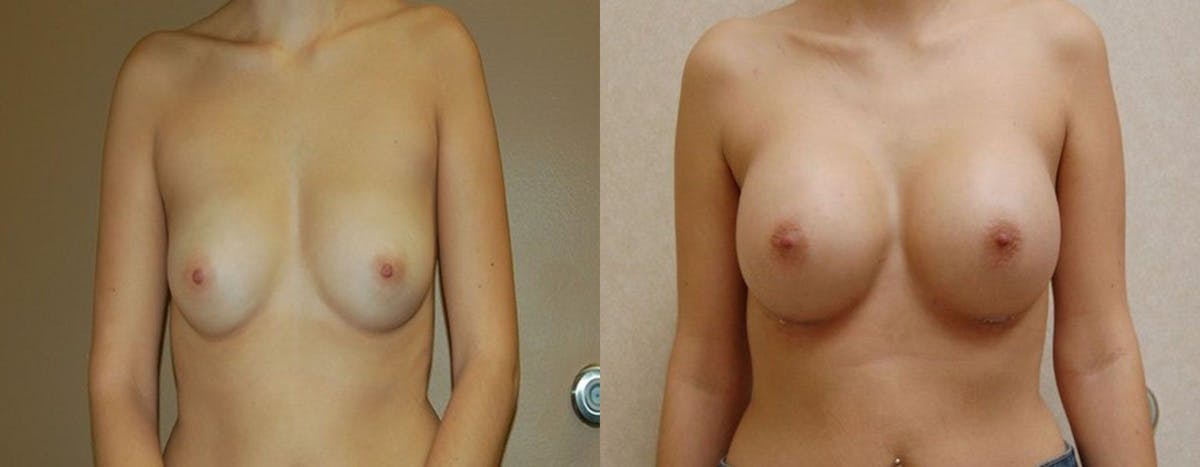 Breast Augmentation Before & After Gallery - Patient 296175 - Image 1