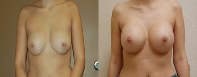 Breast Augmentation Before & After Gallery - Patient 296175 - Image 1