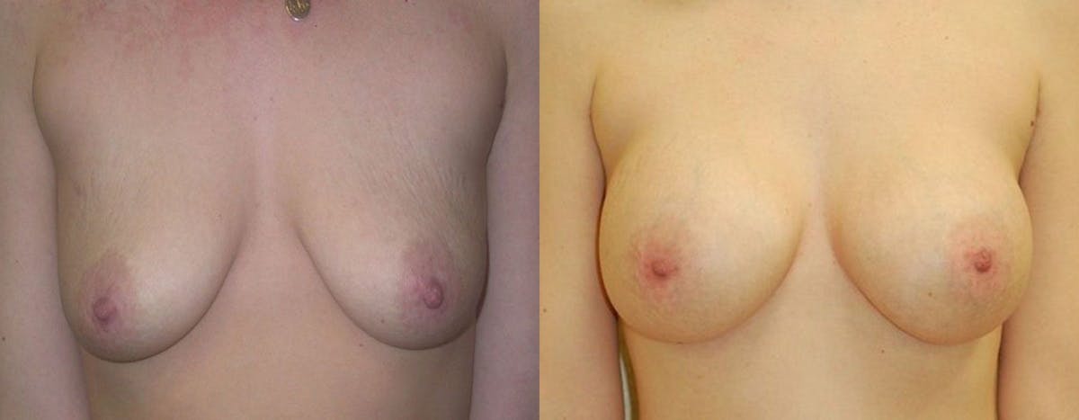 Breast Augmentation Before & After Gallery - Patient 177462 - Image 1