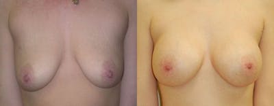 Breast Augmentation Before & After Gallery - Patient 177462 - Image 1
