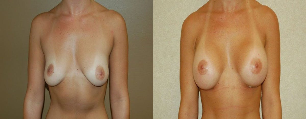 Breast Augmentation Before & After Gallery - Patient 106652 - Image 1