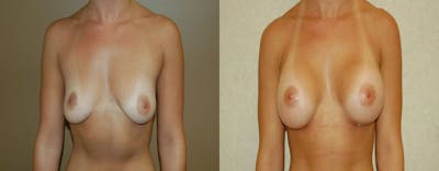 Breast Augmentation Before & After Gallery - Patient 106652 - Image 1