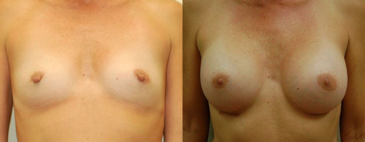 Breast Augmentation Before & After Gallery - Patient 315202 - Image 1
